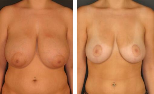 Front torso view of woman’s large sagging breasts before breast reduction surgery and smaller, perkier breasts after.