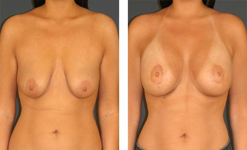 Woman with larger, perkier breasts after becoming a patient of Dr. Newman