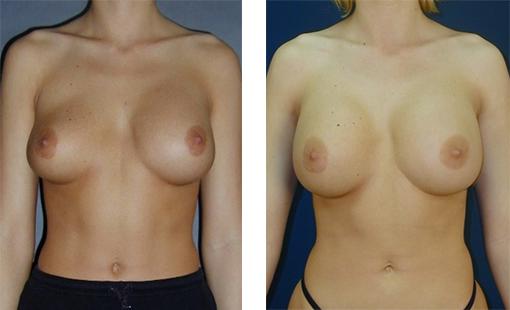 A woman with asymmetrical breast implants, and symmetrical breast implants after becoming a patient of Dr. Newman
