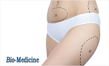 Dr. Scott Newman of New York Exclusively Offers SculpSure, a Recolutionary Fat Reduction Procedure