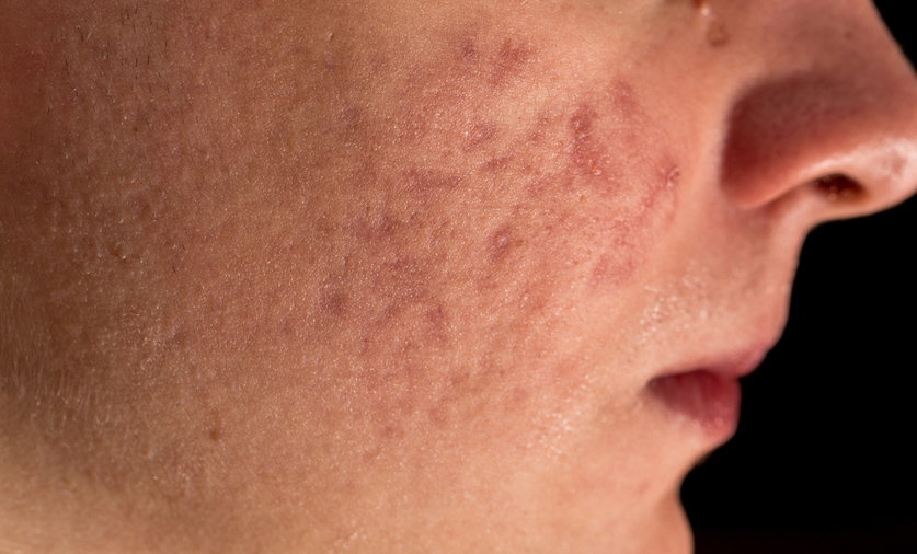 acne scars in NYC