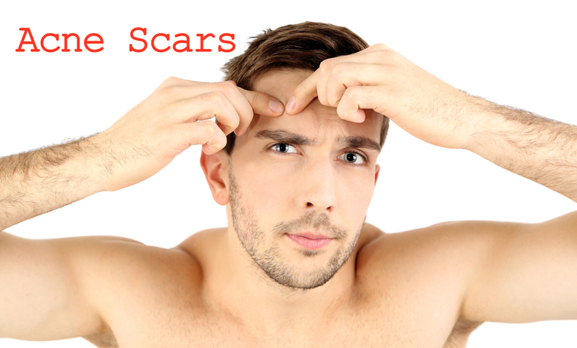 The Evolution Of Acne Scar Removal Technology Newman