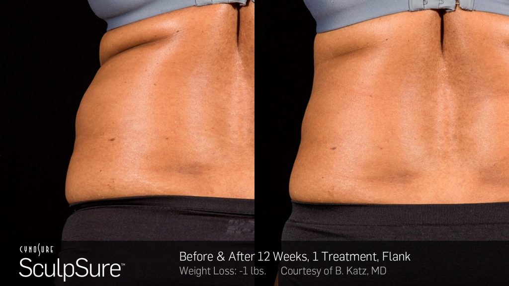 SculpSure before and after photos of woman's back