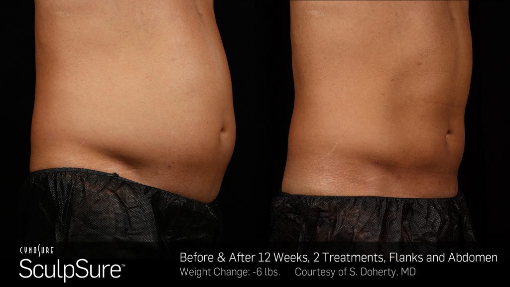SculpSure before and after photos of male abdomen