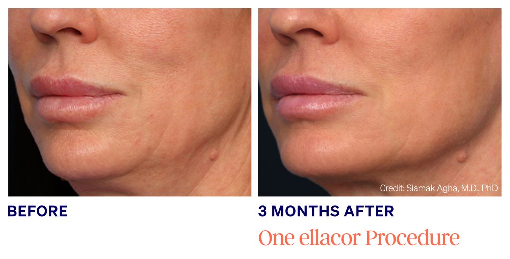 Patient face before and three months after one ellacor treatment