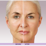 Dermal Fillers — Hyaluronic Acid New York