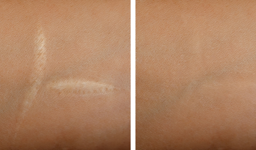 scar treatments