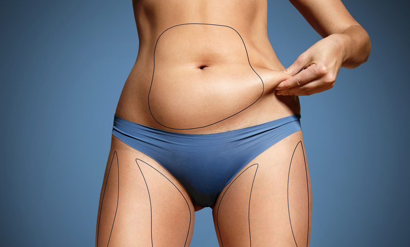 CoolSculpting