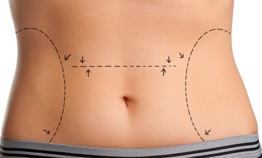 body cosmetic surgery