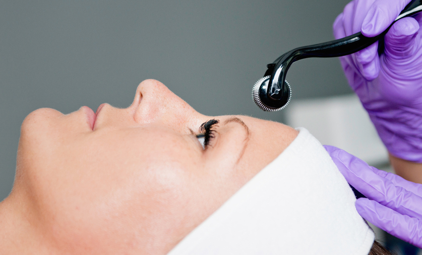 microneedling