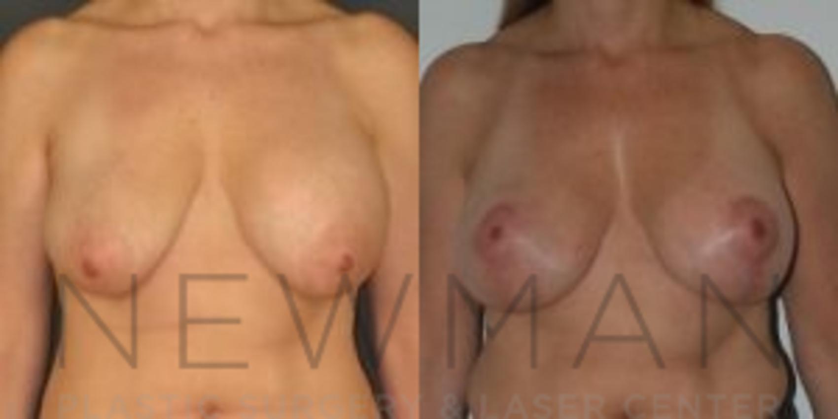 Breast Asymmetry before and after case 72