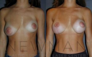 Breast Augmentation before and after, case 73, Front view