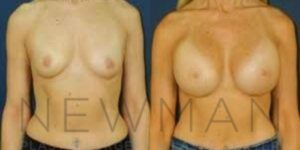 Before & after case 101