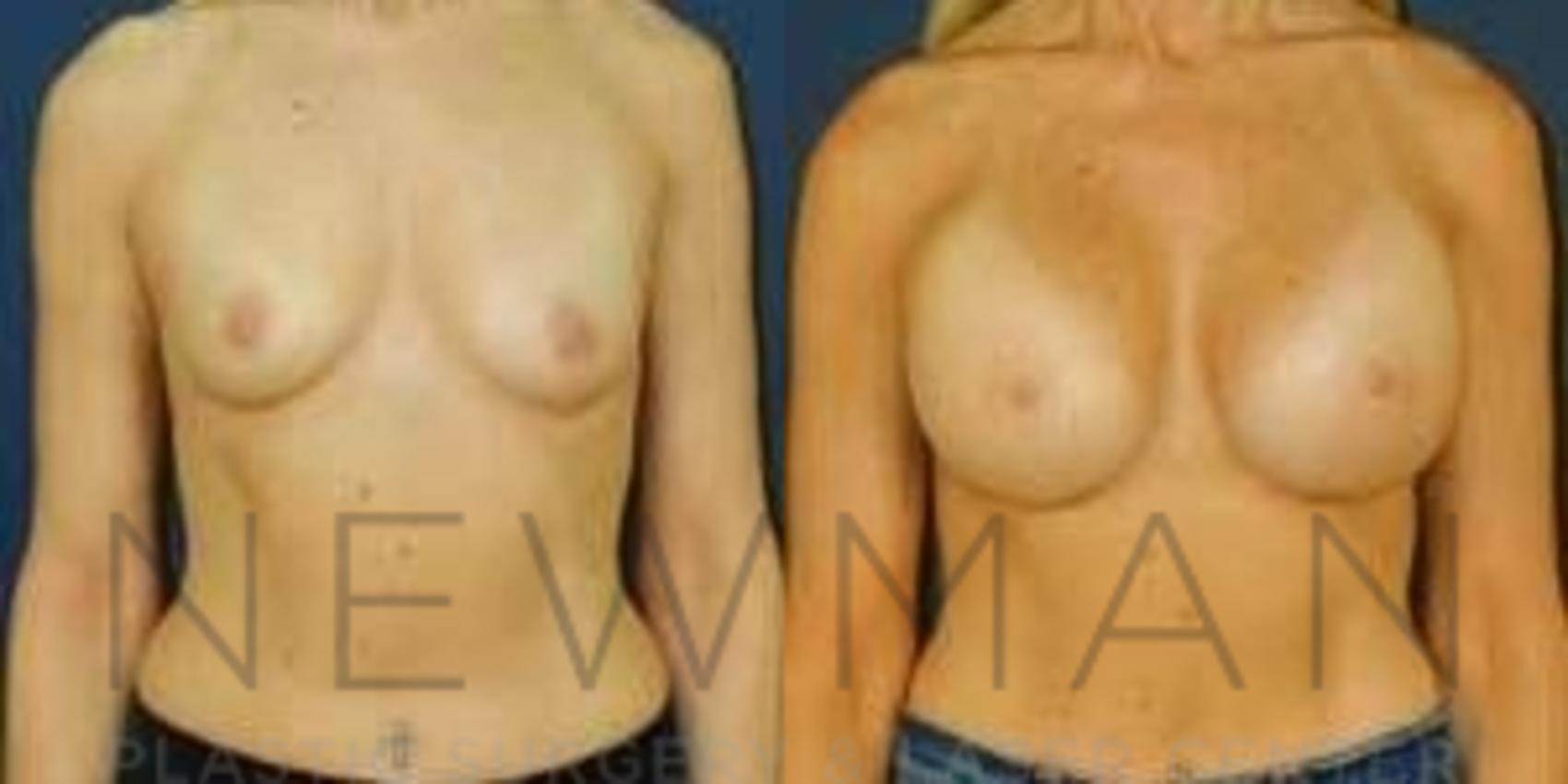 Breast Augmentation before and after case 101