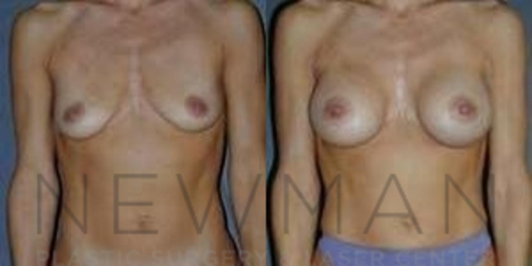 Breast Augmentation before and after case 102