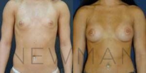 Before & after case 103