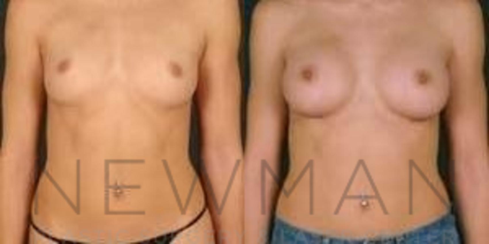 Breast Augmentation before and after case 106