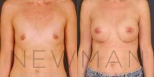 Before & after case 107