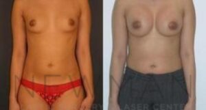 Breast Augmentation before and after, case 110, Front view