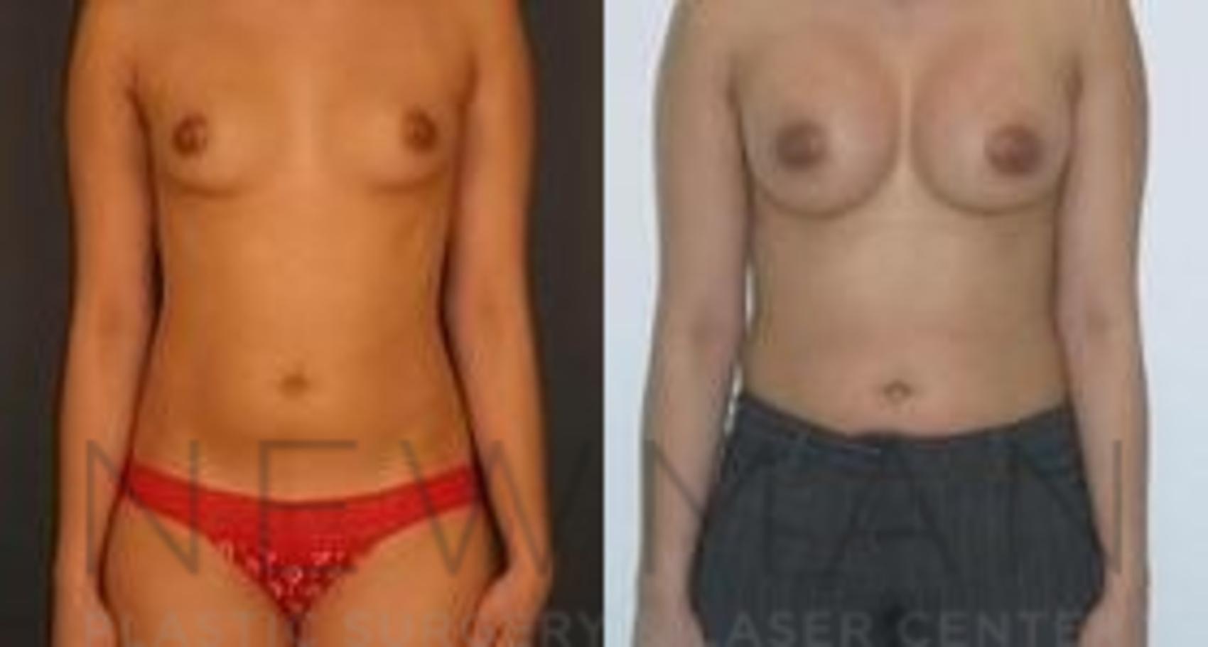 Breast Augmentation before and after case 110