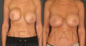 Breast Augmentation before and after, case 111, Front view