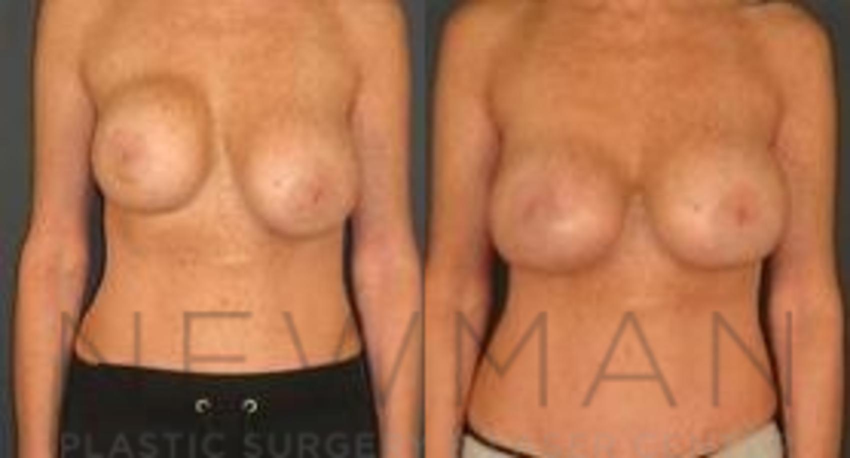 Breast Augmentation before and after case 111