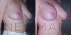 Before & after case 113