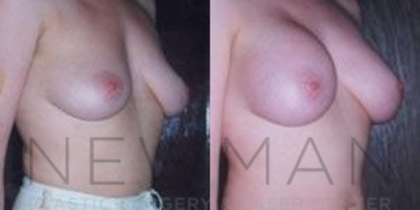Breast Augmentation before and after case 113