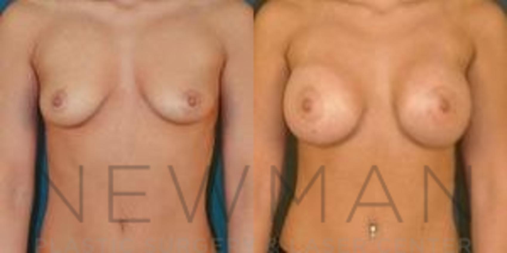 Breast Augmentation before and after case 115