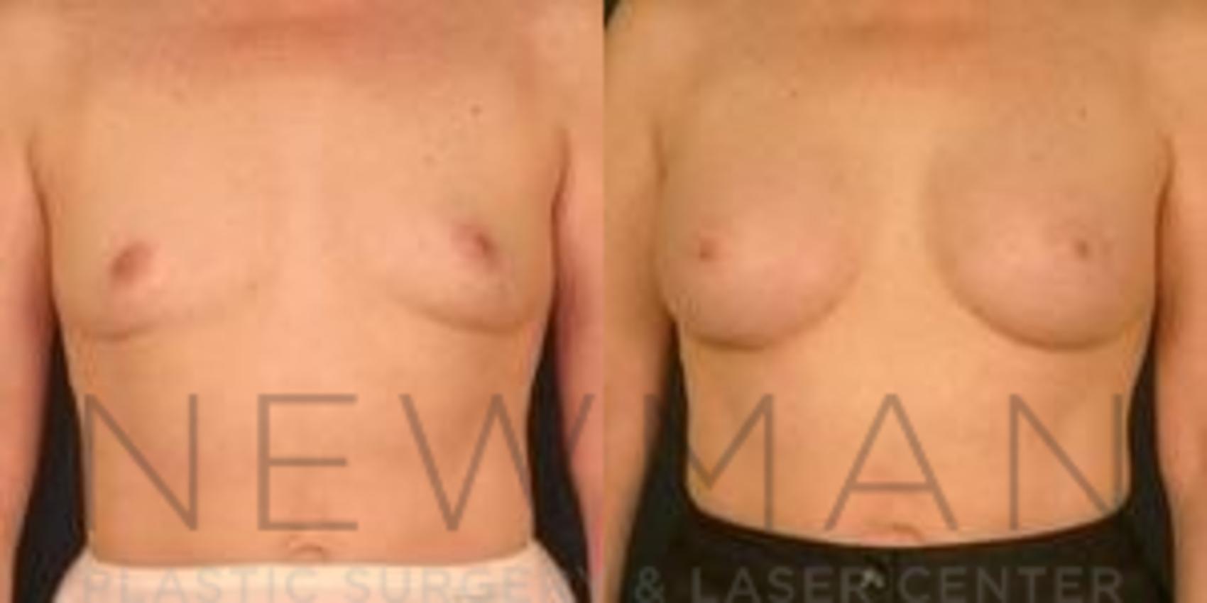 Breast Augmentation before and after case 116