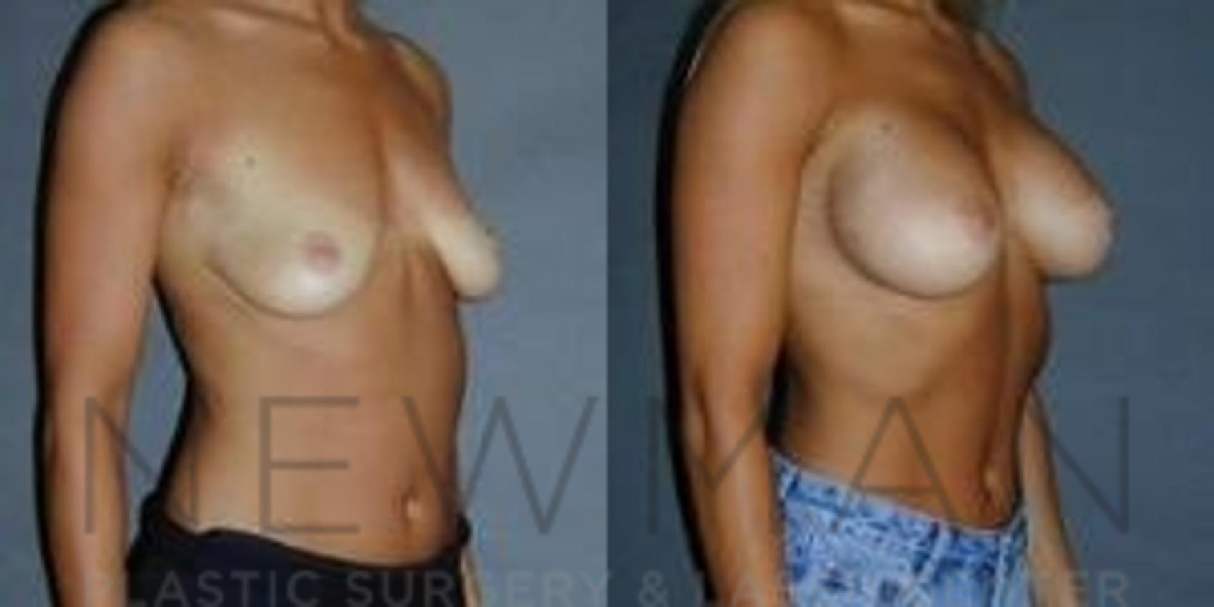 Breast Augmentation before and after case 117
