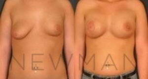 Breast Augmentation before and after, case 118, Front view