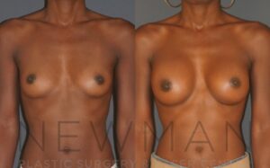 Breast Augmentation before and after, case 12, Front view