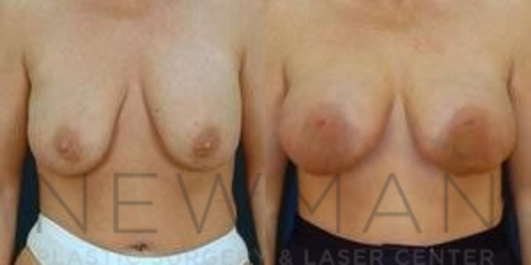 Breast Augmentation before and after case 120