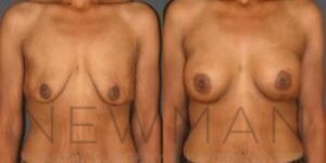 Before & after case 121