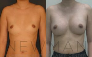 Before & after case 13