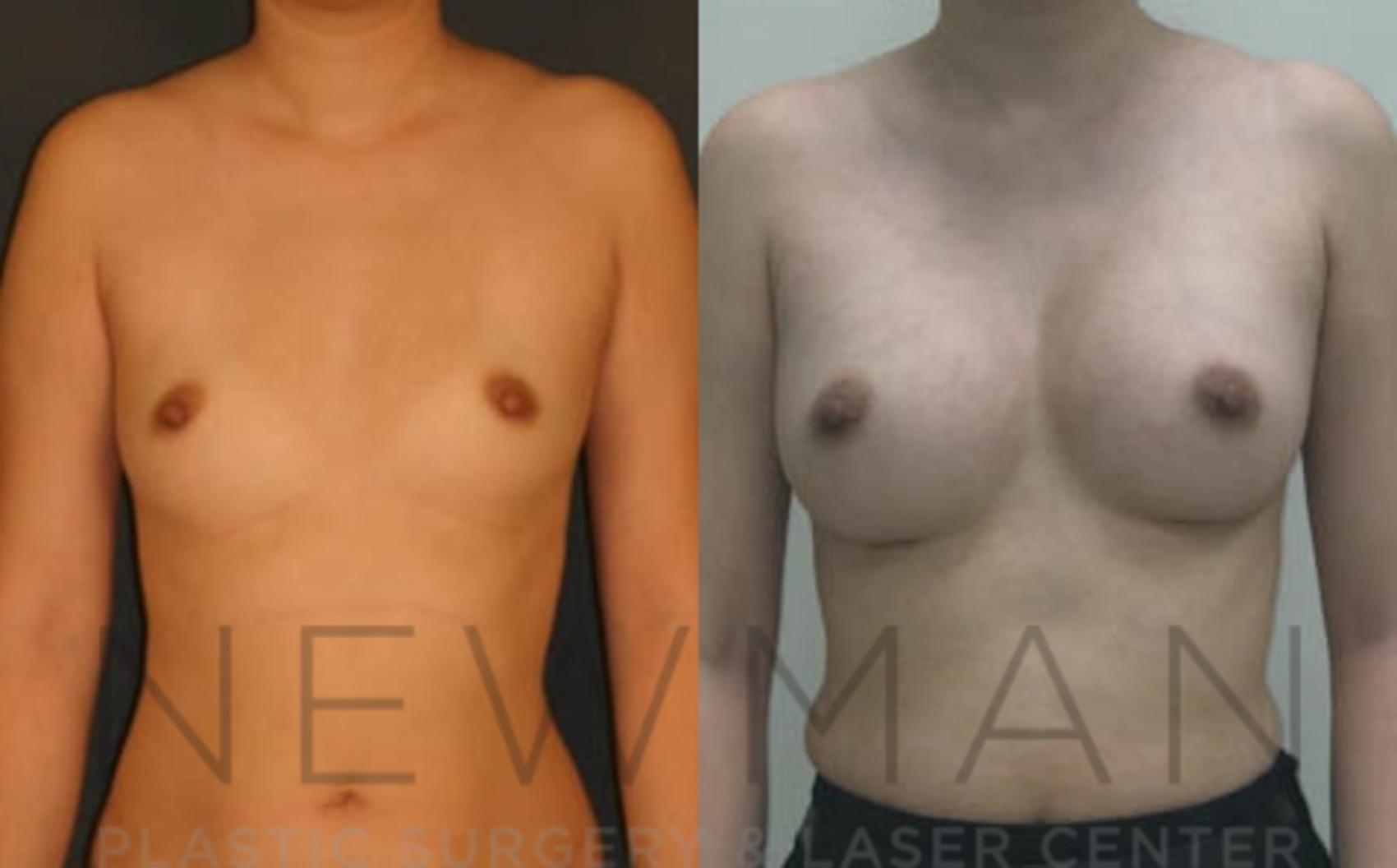 Breast Augmentation before and after case 13