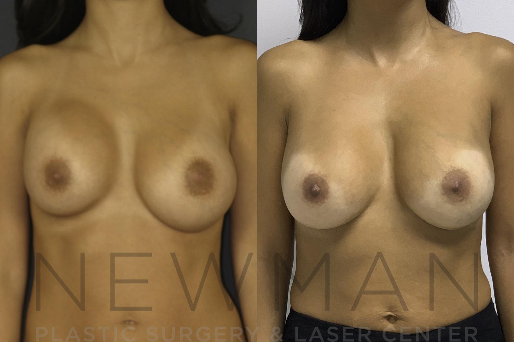 Breast Asymmetry before and after case 134