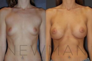 Case #14 before and after