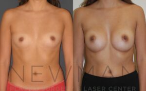 Breast Augmentation before and after, case 17, Front view