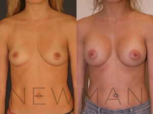 Before & after case 18