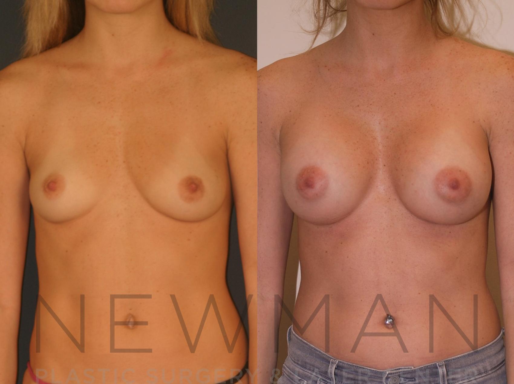 Breast Augmentation before and after case 18