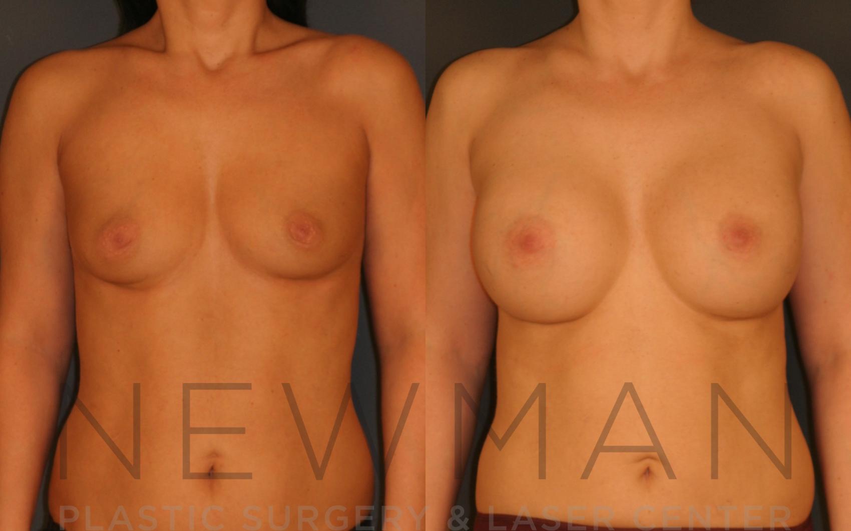 Breast Augmentation before and after case 19