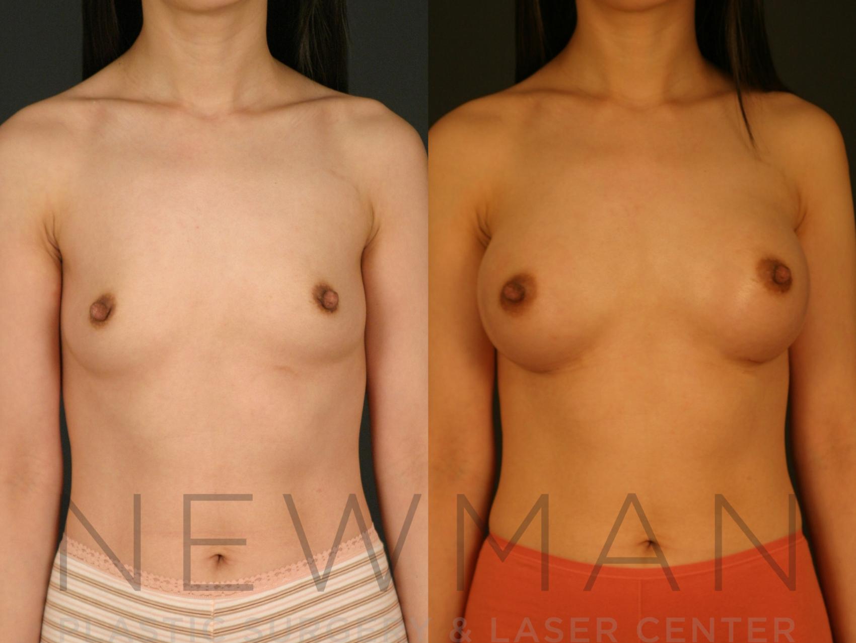 Breast Augmentation before and after case 20