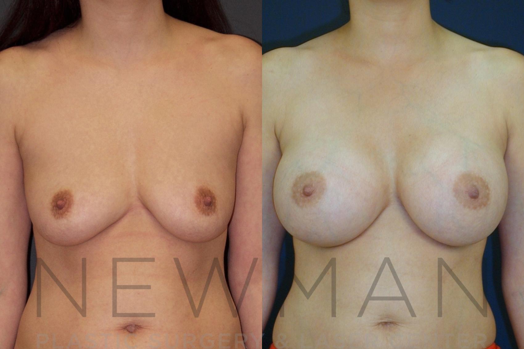 Breast Augmentation before and after case 22