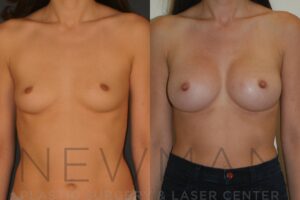 Breast Augmentation before and after, case 23, Front view