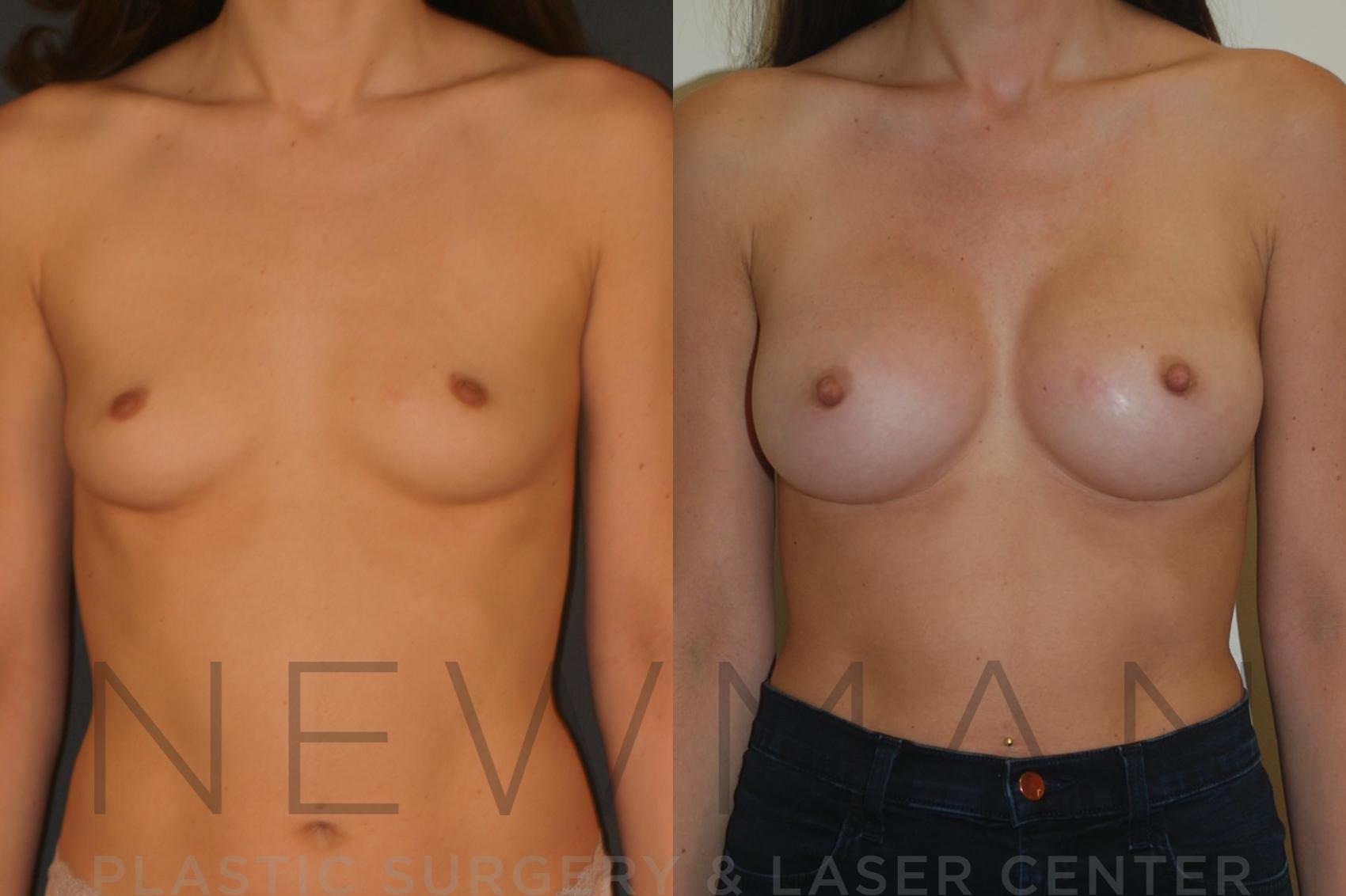 Breast Augmentation before and after case 23