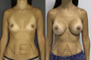 Breast Augmentation before and after, case 24, Front view