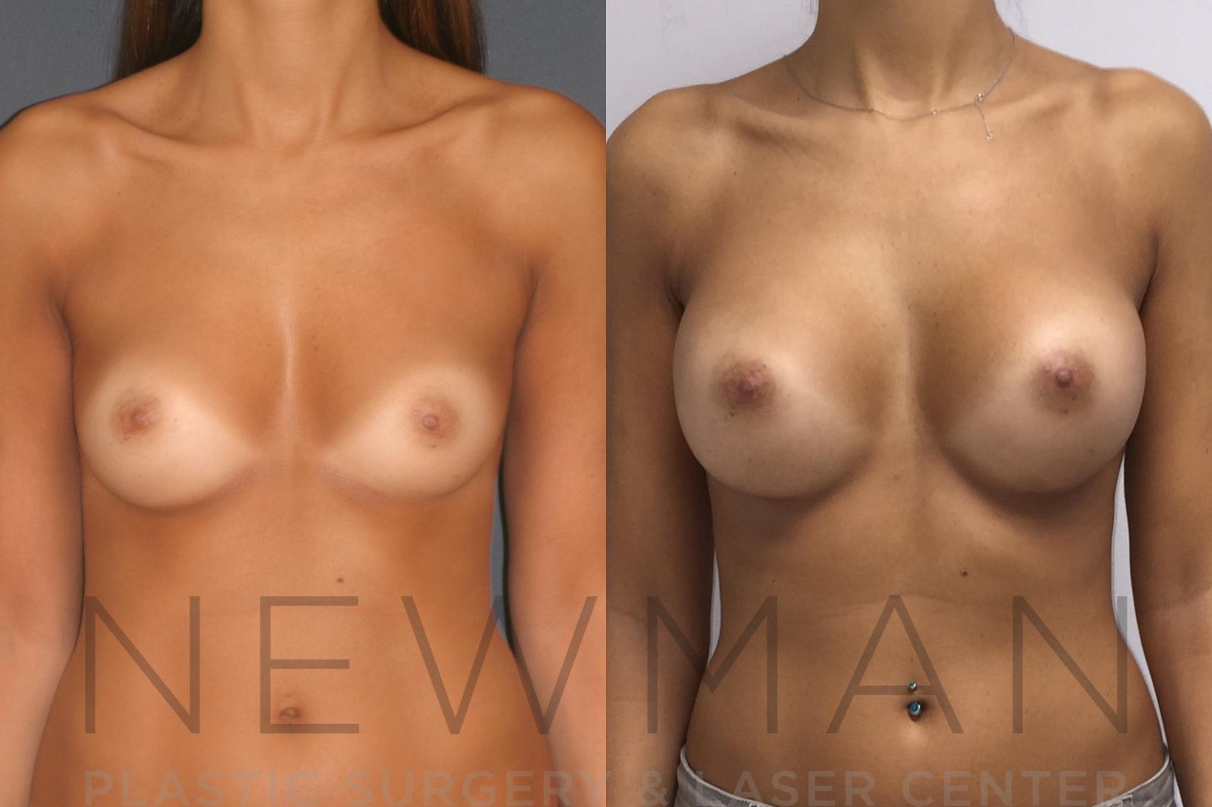 Breast Augmentation before and after case 25