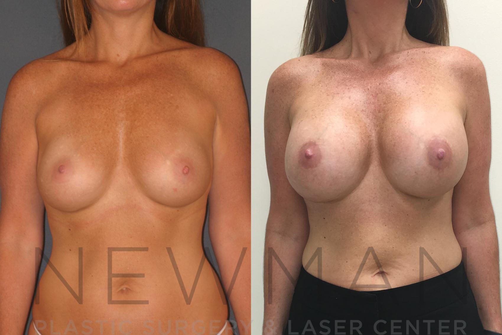 Breast Augmentation before and after case 26
